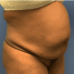 Tummy Tuck Before & After Patient #2699