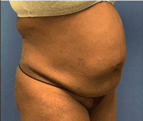 Tummy Tuck Before & After Patient #2699
