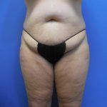 Tummy Tuck Before & After Patient #2704