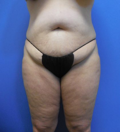 Tummy Tuck Before & After Patient #2704