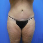 Tummy Tuck Before & After Patient #2704