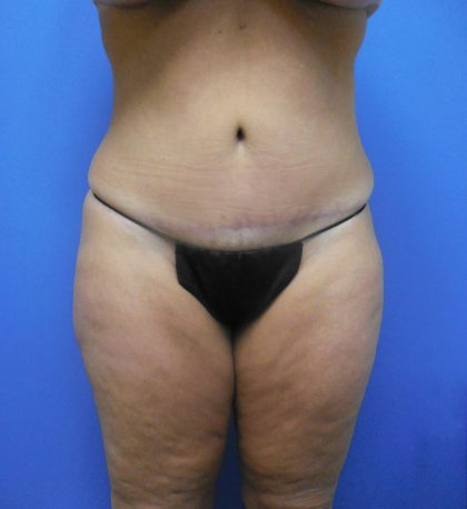 Tummy Tuck Before & After Patient #2704