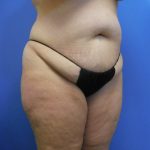 Tummy Tuck Before & After Patient #2704