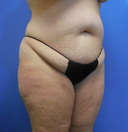 Tummy Tuck Before & After Patient #2704