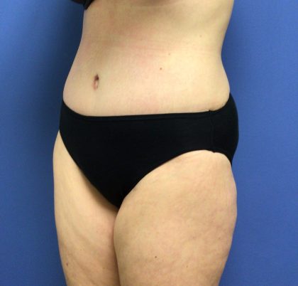 Tummy Tuck Before & After Patient #2709