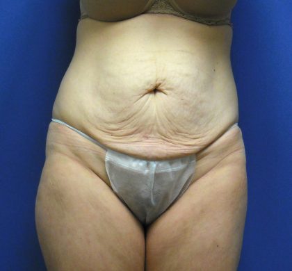 Tummy Tuck Before & After Patient #2709