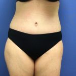 Tummy Tuck Before & After Patient #2709