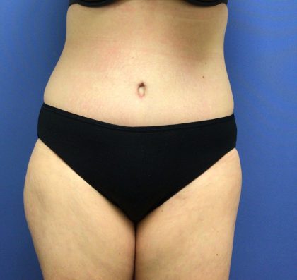 Tummy Tuck Before & After Patient #2709
