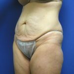 Tummy Tuck Before & After Patient #2709