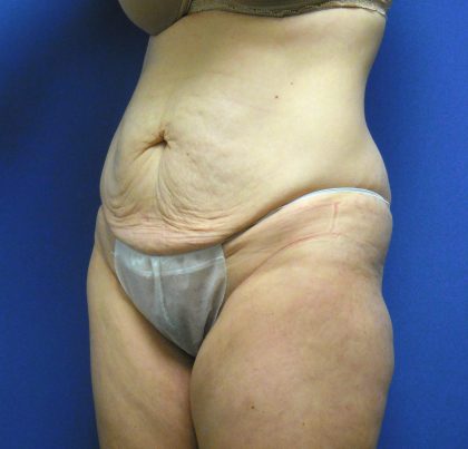 Tummy Tuck Before & After Patient #2709