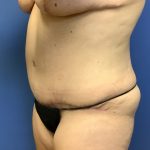 Tummy Tuck Before & After Patient #2714