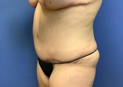 Tummy Tuck Before & After Patient #2714