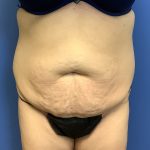 Tummy Tuck Before & After Patient #2714