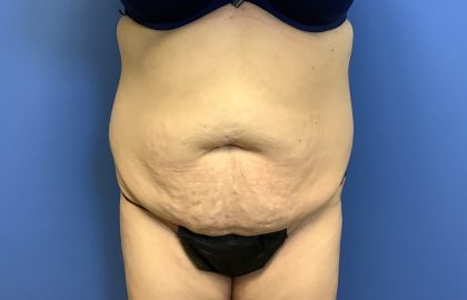 Tummy Tuck Before & After Patient #2714