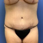 Tummy Tuck Before & After Patient #2714