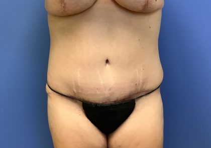 Tummy Tuck Before & After Patient #2714