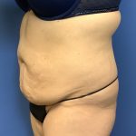 Tummy Tuck Before & After Patient #2714