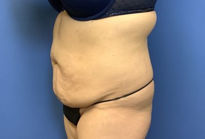 Tummy Tuck Before & After Patient #2714