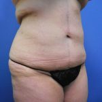 Tummy Tuck Before & After Patient #2719