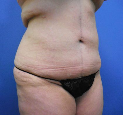 Tummy Tuck Before & After Patient #2719