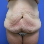 Tummy Tuck Before & After Patient #2719