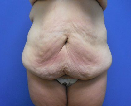 Tummy Tuck Before & After Patient #2719