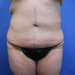 Tummy Tuck Before & After Patient #2719