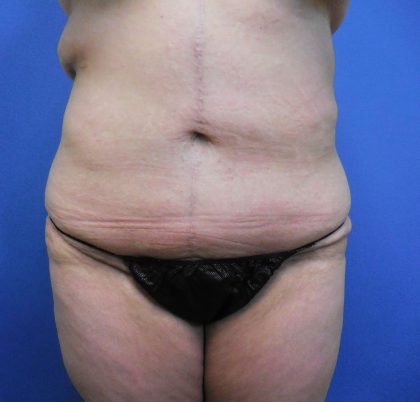 Tummy Tuck Before & After Patient #2719