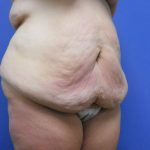 Tummy Tuck Before & After Patient #2719