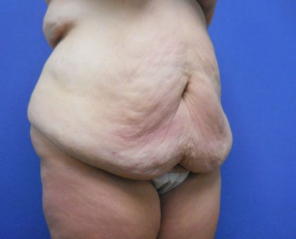 Tummy Tuck Before & After Patient #2719