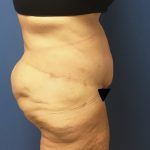 Tummy Tuck Before & After Patient #2724