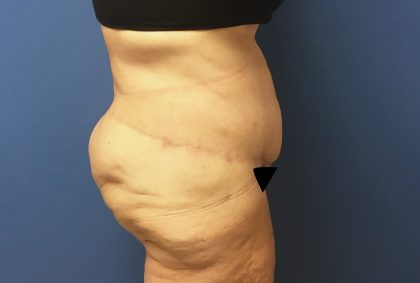 Tummy Tuck Before & After Patient #2724