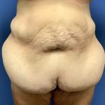 Tummy Tuck Before & After Patient #2724