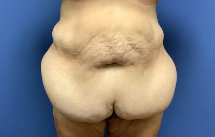 Tummy Tuck Before & After Patient #2724