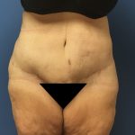 Tummy Tuck Before & After Patient #2724