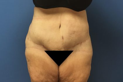 Tummy Tuck Before & After Patient #2724