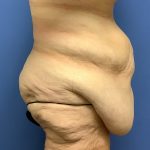 Tummy Tuck Before & After Patient #2724