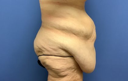 Tummy Tuck Before & After Patient #2724