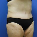 Tummy Tuck Before & After Patient #2729