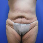 Tummy Tuck Before & After Patient #2729