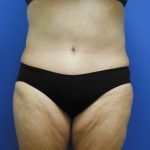 Tummy Tuck Before & After Patient #2729