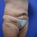Tummy Tuck Before & After Patient #2729