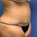 Tummy Tuck Before & After Patient #2734