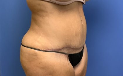 Tummy Tuck Before & After Patient #2734