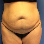 Tummy Tuck Before & After Patient #2734