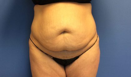 Tummy Tuck Before & After Patient #2734