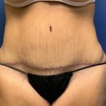 Tummy Tuck Before & After Patient #2734