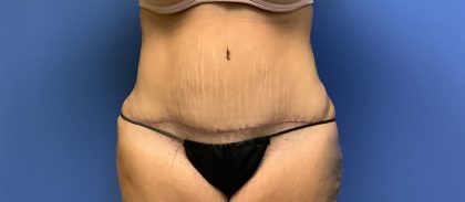 Tummy Tuck Before & After Patient #2734