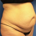 Tummy Tuck Before & After Patient #2734