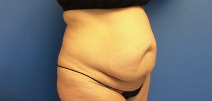 Tummy Tuck Before & After Patient #2734